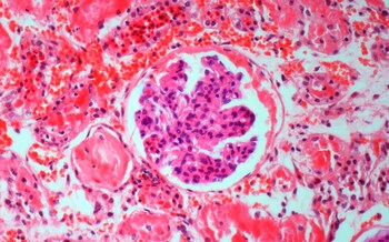 Light micrograph of a section through an inflamed kidney showing a glomerulus, the filtering unit of the organ